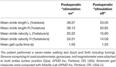 Long-Term Effect of GPi-DBS in a Patient With Generalized Dystonia Due to GLUT1 Deficiency Syndrome